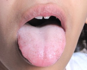 White Coated Tongue Pictures