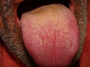 Coated Tongue pictures