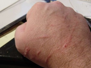 Cat Scratch Disease pics