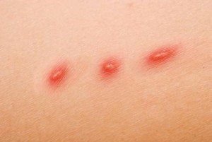 cat scratch fever symptoms