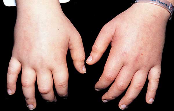 Minimal Change Disease  edema picture