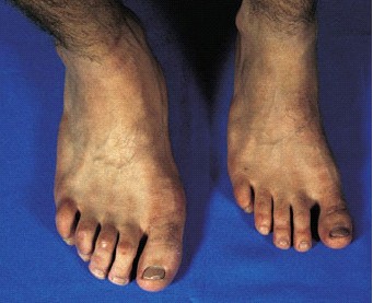 Gigantism foot image