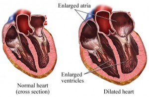 Hypertensive Heart Disease Picture