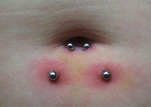 Infected Belly Button Piercing Pictures