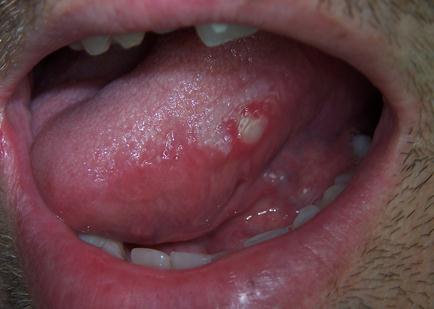 Sore Tongue – Causes, Symptoms, Treatment, Remedies