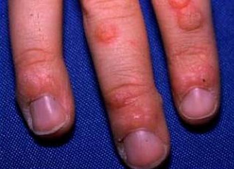 Flat-Warts-on-Hands