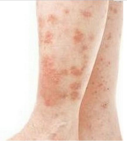 Flat-Warts-on-Legs