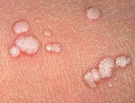 Flat-warts-on-skin