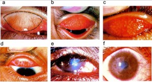 trachoma picture