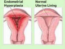 Bleeding after menopause anatomy