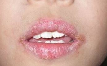 Chapped Lips