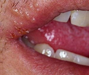 A rampant lip pimple due to cold sores or herpes.picture