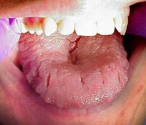 A tongue with severe teeth markings on the sides.picture