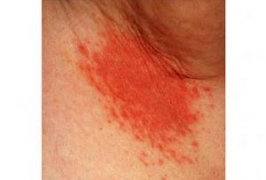 An armpit rash characterized by severe redness and bump-like formation.image