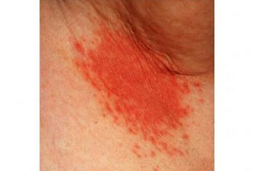 An armpit rash characterized by severe redness and bump-like formation.image